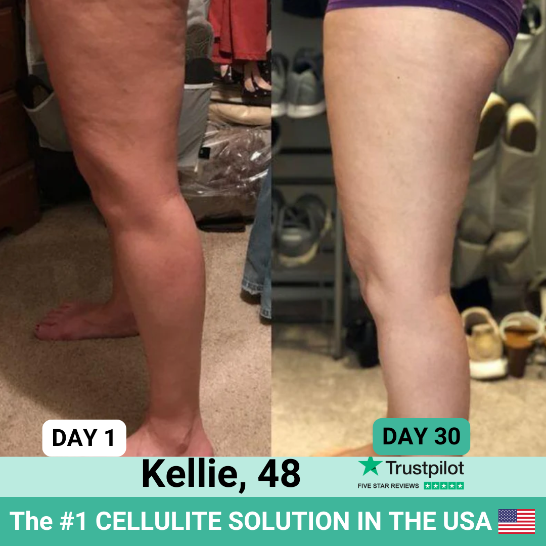 Euphranor™ : Say goodbye to your cellulite now